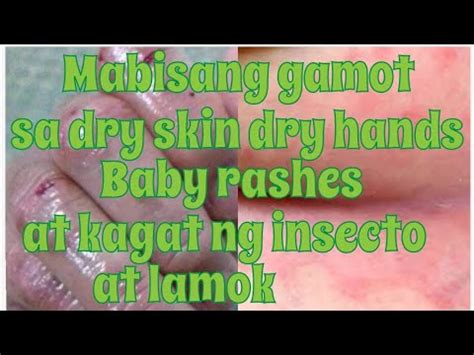 Mabisang Gamot Sa Rashes Sa Pwet .